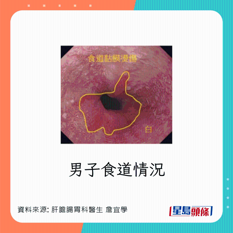 男患者食道灼伤，可恶化成食道癌