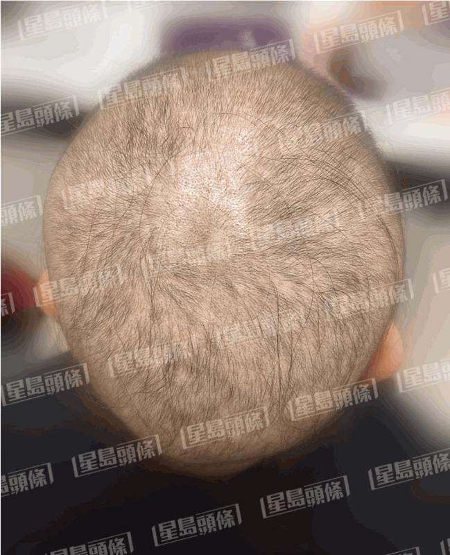 脫髮女子治療一個星期後的進度。(相片由註冊中醫師陳嬿珺提供)