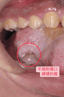 舌癌病变情况 舌癌病变情况