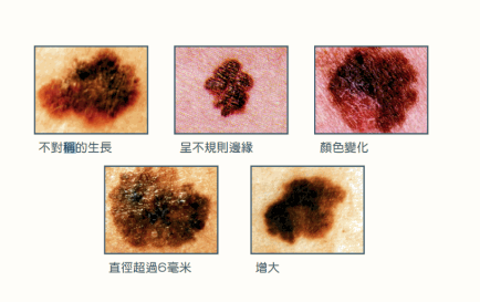 黑痣 黑痣