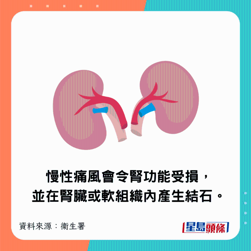 慢性痛风会令肾功能受损,并在肾脏或软组织内产生结石。 慢性痛风会令肾功能受损,并在肾脏或软组织内产生结石。