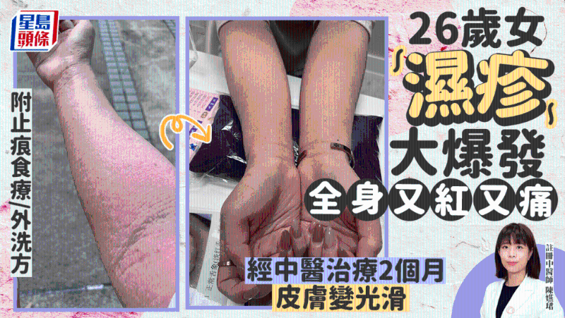 患湿疹常复发 患湿疹常复发