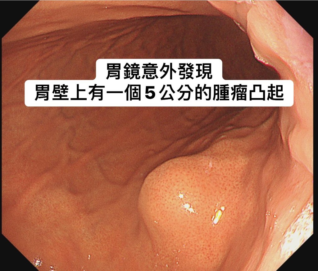 该女子有胰脏癌、乳癌及胆管癌的家族病史 该女子有胰脏癌、乳癌及胆管癌的家族病史