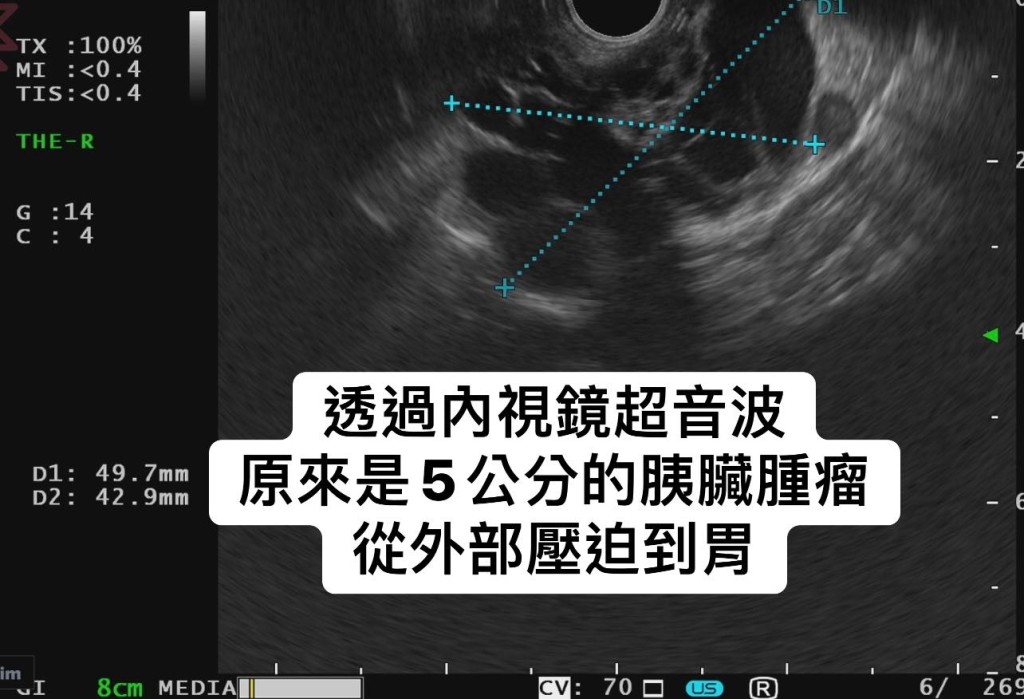 进一步接受胰脏超声波内窥镜检查 进一步接受胰脏超声波内窥镜检查