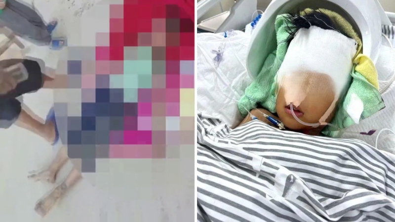 7岁男童被同村男子砸致颅骨粉碎性骨折,疑因骑车压了对方的鸡饲料。 7岁男童被同村男子砸致颅骨粉碎性骨折,疑因骑车压了对方的鸡饲料。