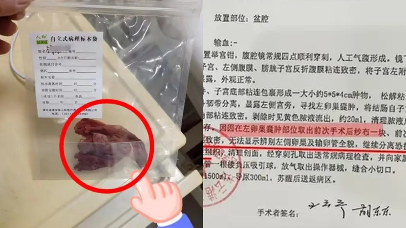 江苏妇4年前手术纱布遗留体内,被迫切除输卵管。 江苏妇4年前手术纱布遗留体内,被迫切除输卵管。
