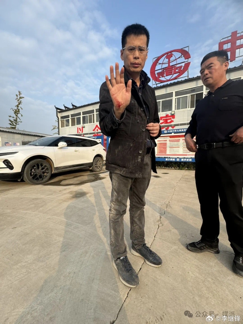 王文志右手受伤流血。(微博)