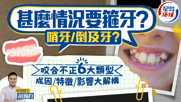 什么情况要箍牙? 什么情况要箍牙?