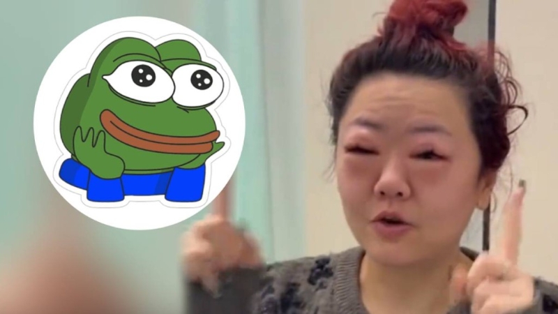 广东女子因吃太多车厘子，令双眼严重肿涨。
