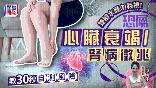 双脚水肿勿轻视! 双脚水肿勿轻视!
