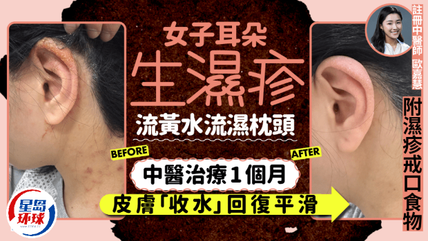 湿疹