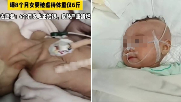 疑遭虐待的八个月大女婴，送院时（左）严重营养不良。