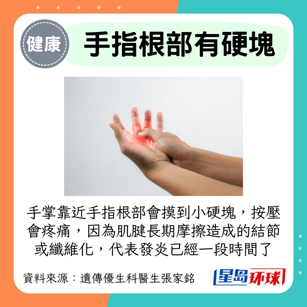 手掌靠近手指根部会摸到小硬块，按压会疼痛，因为肌腱长期摩擦造成的结节或纤维化，代表发炎已经一段时间了