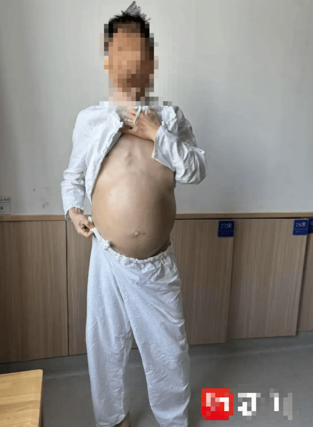 患者腹部严重膨隆，如十月怀胎孕妇。