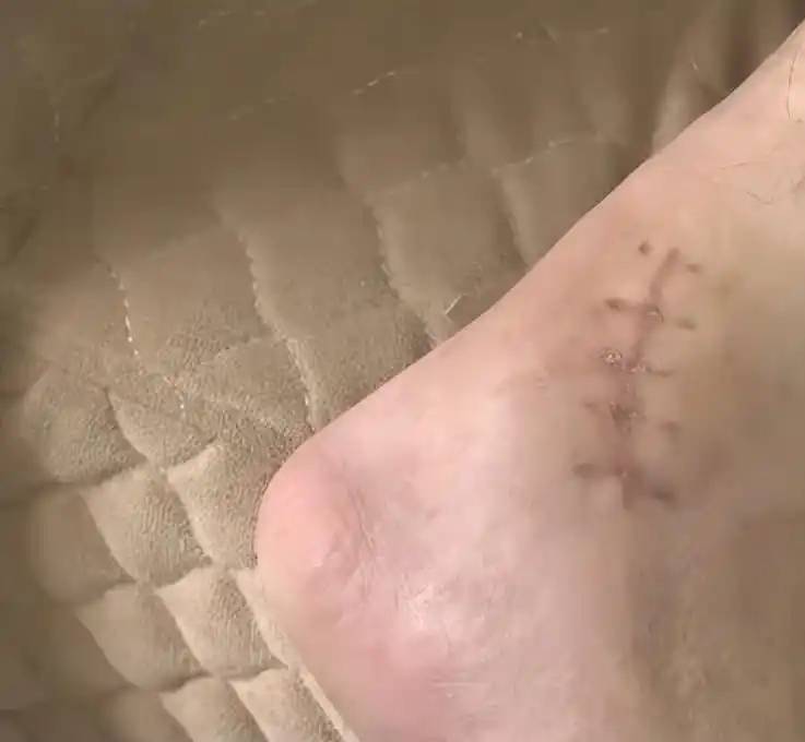 邱先生踝关节骨折。