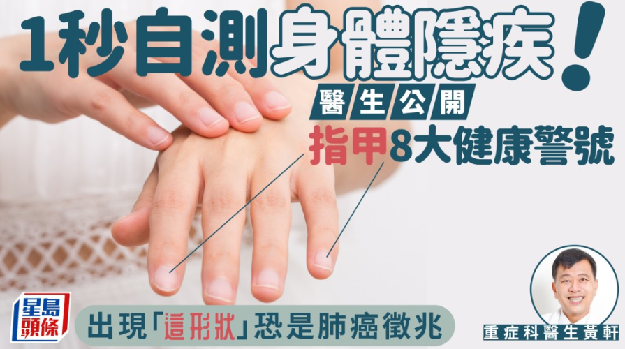 1秒自测身体隐疾！医生公开指甲8大健康警号，出现“这形状”恐是肺癌征兆